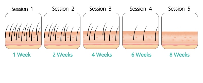 Professional Permanent IPL Laser Depilator